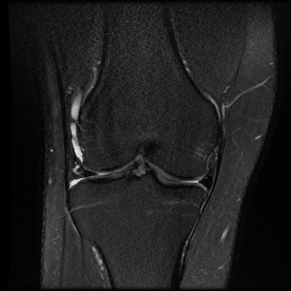 File:Anterior cruciate ligament tear with posteromedial corner injury, bucket-handle meniscal tear and chondral delamination (Radiopaedia 75501-86744 Coronal PD fat sat 13).jpg