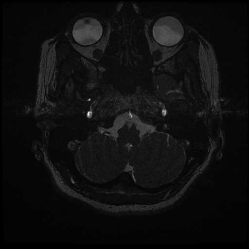 Anterior inferior cerebellar artery vascular loop - type II (Radiopaedia 70991-81209 Axial 3D FIESTA 66).jpg