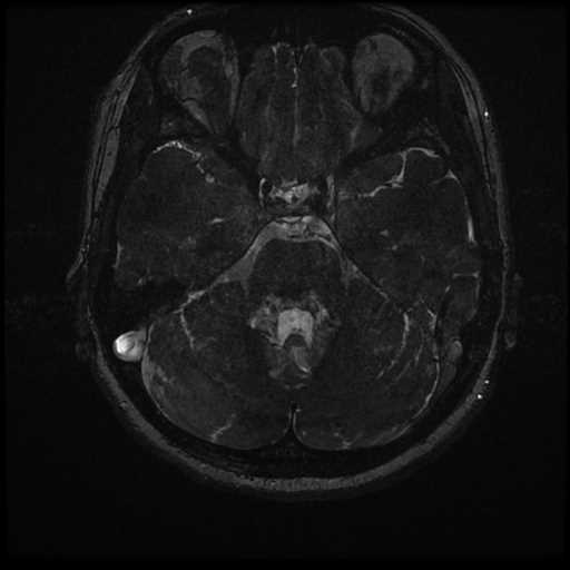 Anterior inferior cerebellar artery vascular loop - type II (Radiopaedia 70991-81209 Axial 3D FIESTA 8).jpg