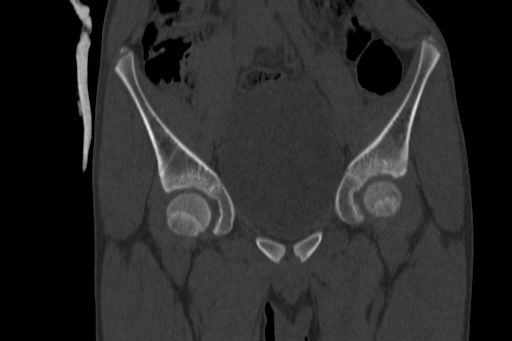 Anterior inferior iliac spine avulsion injury (Radiopaedia 88666-105376 Coronal bone window 27).jpg