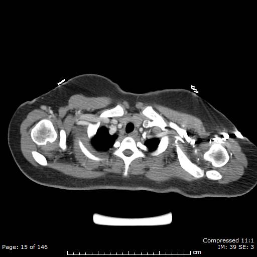 File:Anterior mediastinal B cell Lymphoma (Radiopaedia 50677-56114 A 8).jpg