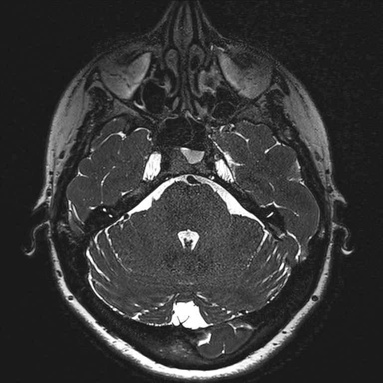 Anterior temporal encephalocele (Radiopaedia 82624-96808 Axial T2 high res 33).jpg