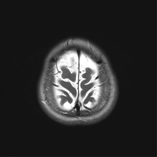 File:Anterior temporal lobe perivascular space (Radiopaedia 40946-43650 Axial T2 35).png