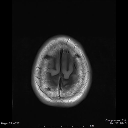 File:Anterior temporal lobe perivascular space (Radiopaedia 88283-104914 Axial T1 27).jpg
