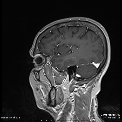 File:Anterior temporal lobe perivascular space (Radiopaedia 88283-104914 Sagittal T1 C+ 9).jpg