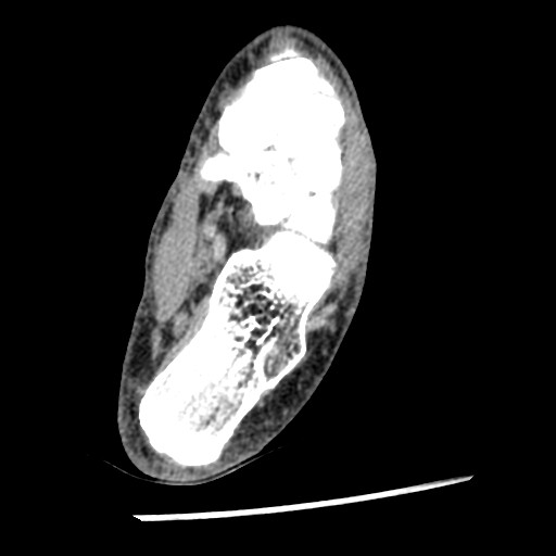 Anterior tibial artery false aneurysm (Radiopaedia 88984-105809 A 185).jpg