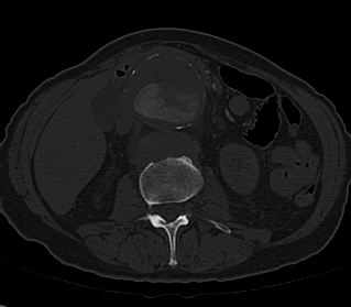 File:Anterior vertebral scalloping (abdominal aortic aneurysm) (Radiopaedia 66744-76067 Axial bone window 1).jpg