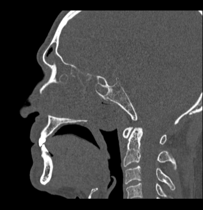 Antrochoanal polyp (Radiopaedia 79011-92169 Sagittal bone window 25).jpg