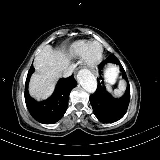 File:Aortic aneurysm and Lemmel syndrome (Radiopaedia 86499-102554 A 12).jpg