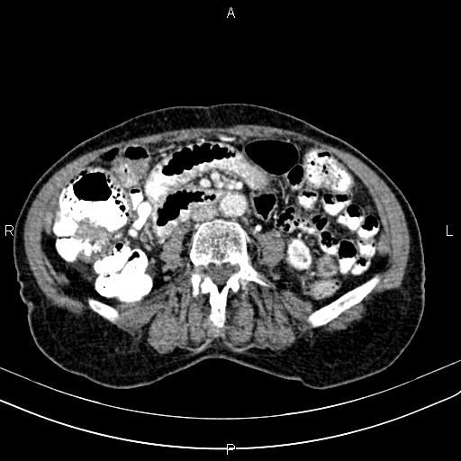 File:Aortic aneurysm and Lemmel syndrome (Radiopaedia 86499-102554 A 45).jpg