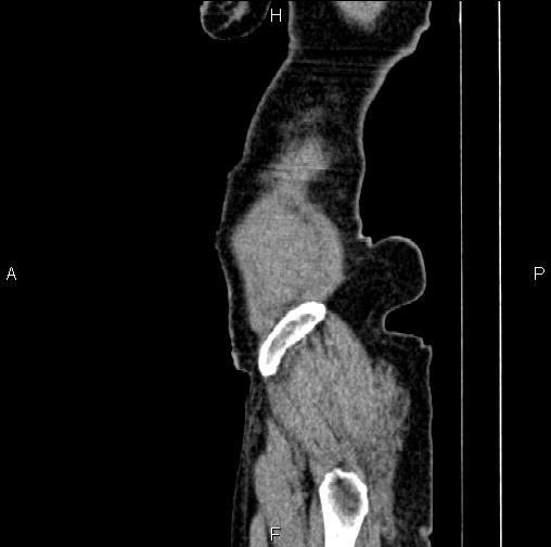 File:Aortic aneurysm and Lemmel syndrome (Radiopaedia 86499-102554 D 90).jpg