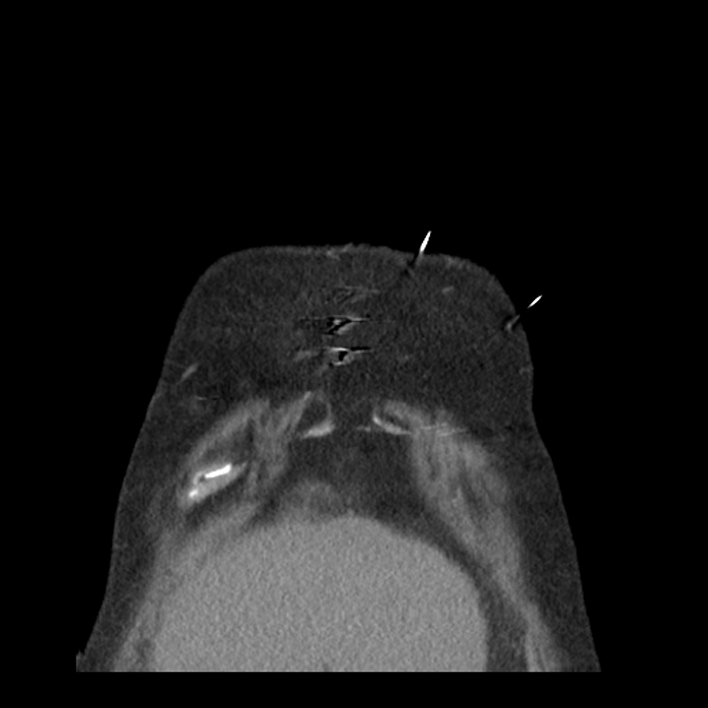 Aortic arch graft infection (FDG PET-CT) (Radiopaedia 71975-82437 Coronal 7).jpg