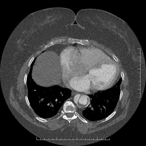 File:Aortic dissection- Stanford A (Radiopaedia 35729-37268 A 70).jpg