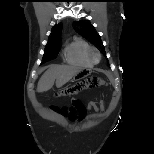 File:Aortic dissection- Stanford A (Radiopaedia 37759-39664 Coronal C+ delayed 5).png