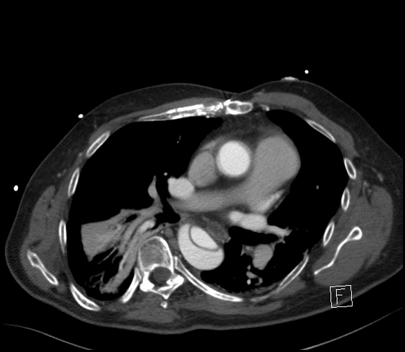 Aortic dissection (CTPA) (Radiopaedia 75506-86750 E 2).jpg