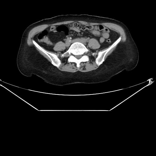 Aortic dissection (Radiopaedia 25350-25604 B 58).jpg
