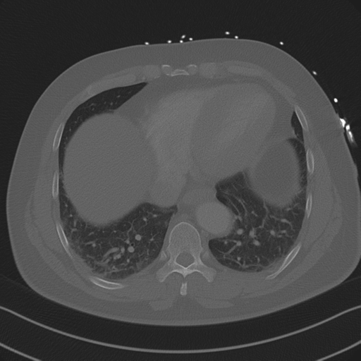 Aortic dissection (Radiopaedia 50763-56234 Axial bone window 76).png