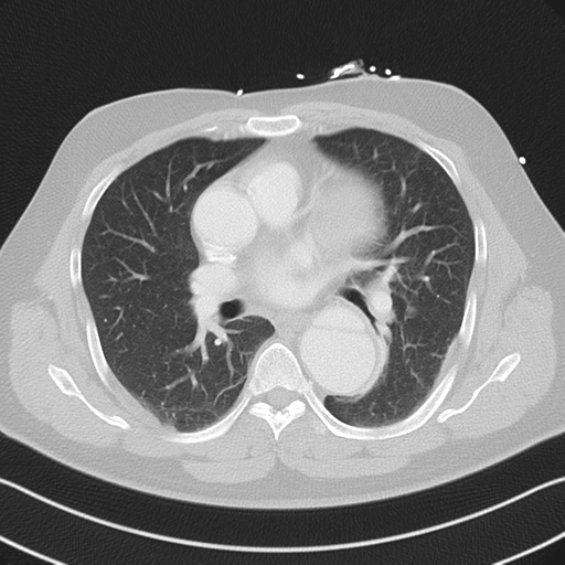File:Aortic dissection (Radiopaedia 50763-56234 Axial lung window 34).png