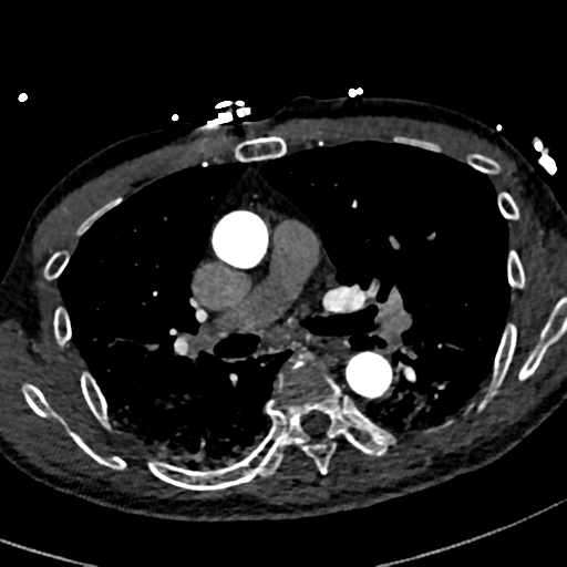 Aortic dissection - DeBakey type II (Radiopaedia 64302-73082 A 39).png
