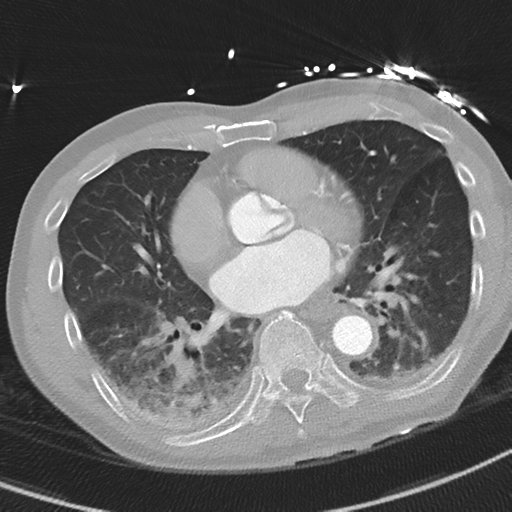 Aortic dissection - DeBakey type II (Radiopaedia 64302-73082 Axial lung window 38).png