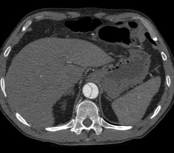 File:Aortic dissection - Stanford type B (Radiopaedia 73648-84437 A 109).jpg