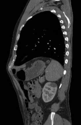 File:Aortic dissection - Stanford type B (Radiopaedia 73648-84437 C 32).jpg