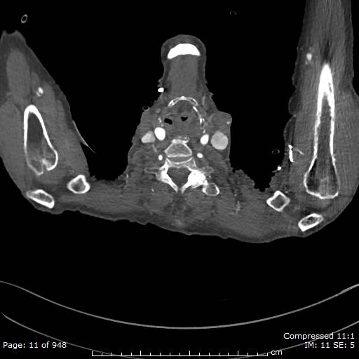 File:Aortic dissection with extension into aortic arch branches (Radiopaedia 64402-73204 B 11).jpg