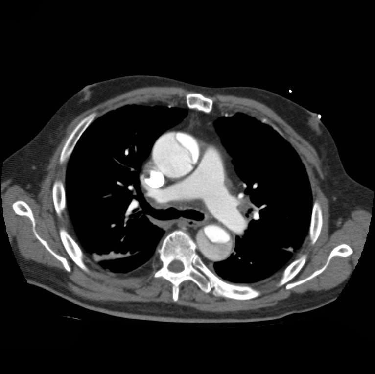 Aortic dissection with rupture into pericardium (Radiopaedia 12384-12647 A 23).jpg