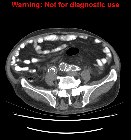 Aortic graft infection (Radiopaedia 44979-48907 Axial non-contrast 65).jpg