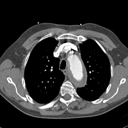 Aortic intramural hematoma (Radiopaedia 31139-31838 B 26).jpg