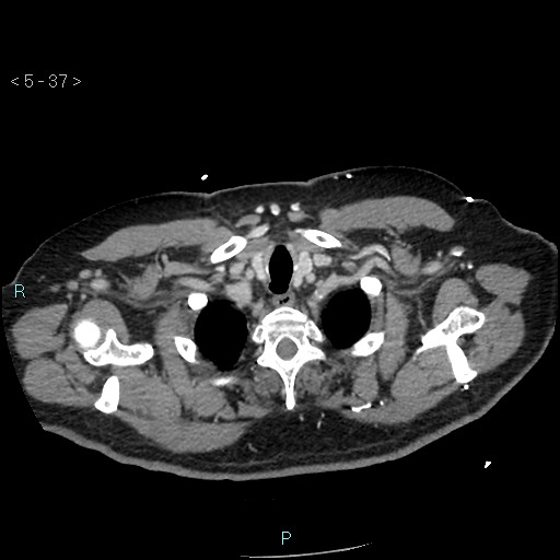 Aortic intramural hematoma (Radiopaedia 48463-53380 C 17).jpg