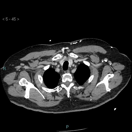 Aortic intramural hematoma (Radiopaedia 48463-53380 C 21).jpg