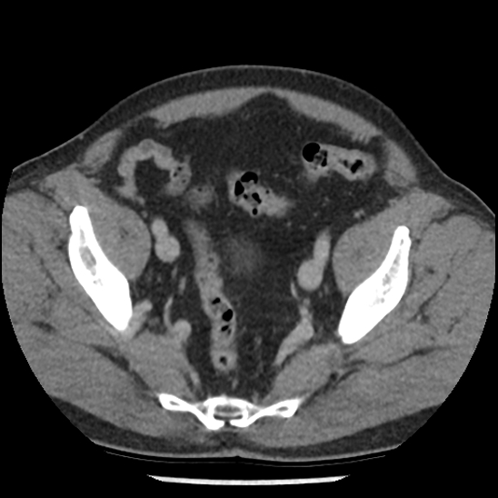 Aortic intramural hematoma (type B) (Radiopaedia 79323-92387 Axial C+ delayed 101).jpg