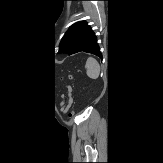 Aortic intramural hematoma (type B) (Radiopaedia 79323-92387 Sagittal C+ delayed 50).jpg