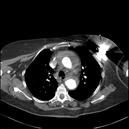 File:Aortic intramural hematoma with dissection and intramural blood pool (Radiopaedia 77373-89491 B 45).jpg