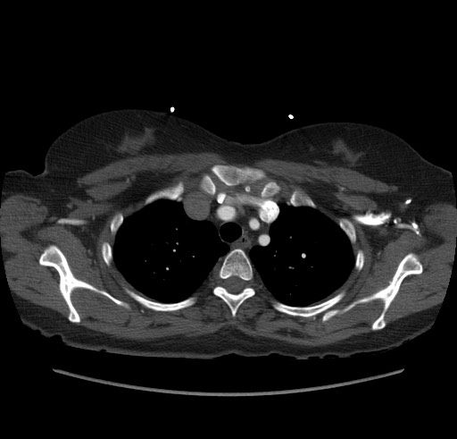 Aortic nipple (Radiopaedia 63008-71449 B 17).jpg