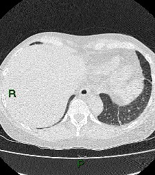 File:Aortic valve endocarditis (Radiopaedia 87209-103485 Axial lung window 83).jpg