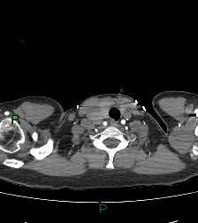 Aortic valve endocarditis (Radiopaedia 87209-103485 C 1).jpg