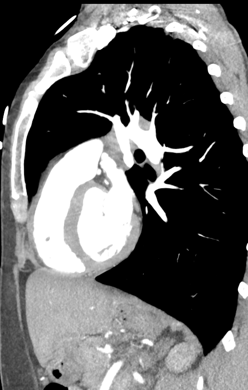 Aortic valve non-coronary cusp thrombus (Radiopaedia 55661-62189 C+ arterial phase 20).png