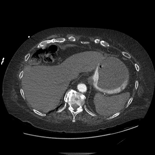 Aortoesophageal fistula with endovascular repair (Radiopaedia 73781-84592 Axial C+ CTPA 154).jpg