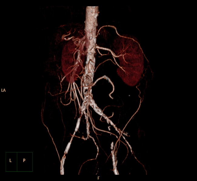 File:Aortoiliac occlusive disease (Radiopaedia 32134-33076 VR C+ arterial phase 10).jpg