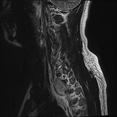 File:Apical lung mass mimic - neurogenic tumor (Radiopaedia 59918-67394 Sagittal T2 16).jpg