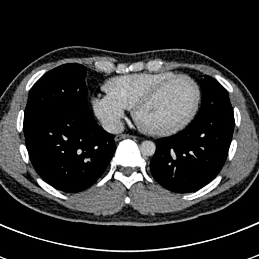 Apical lung mass mimic - neurogenic tumor (Radiopaedia 59918-67521 A 56).jpg