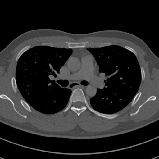 Apical lung mass mimic - neurogenic tumor (Radiopaedia 59918-67521 Axial bone window 34).jpg
