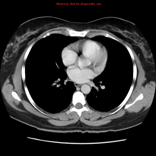 Appendiceal mucinous cystadenoma (Radiopaedia 8263-9111 Axial liver window 4).jpg