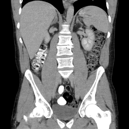 Appendicitis complicated by post-operative collection (Radiopaedia 35595-37113 B 31).jpg