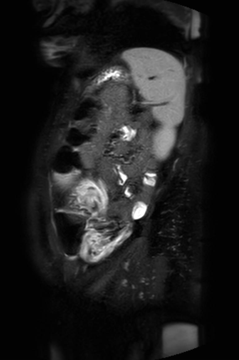 Appendicitis in gravida (MRI) (Radiopaedia 89433-106395 Sagittal T2 SPAIR 13).jpg