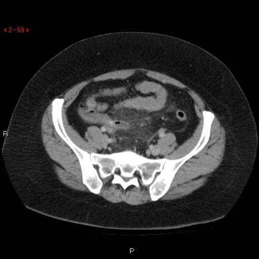 File:Appendicitis with microperforation. promontoric type (Radiopaedia 27268-27442 Axial 2).jpg