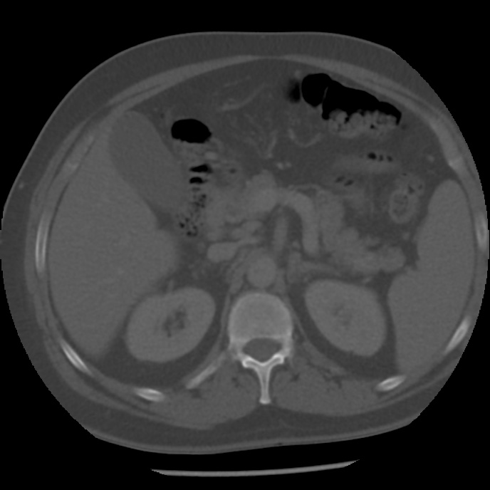 Appendicitis with perforation (Radiopaedia 35790-37342 Axial bone window 16).jpg