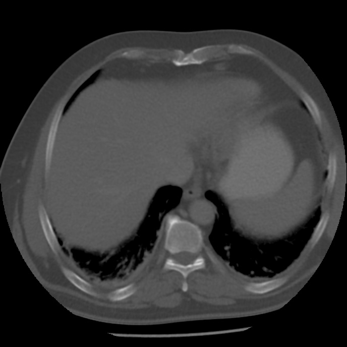Appendicitis with perforation (Radiopaedia 35790-37342 Axial bone window 5).jpg
